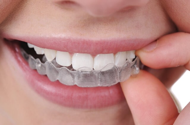 ưu nhược điểm của tẩy trắng răng