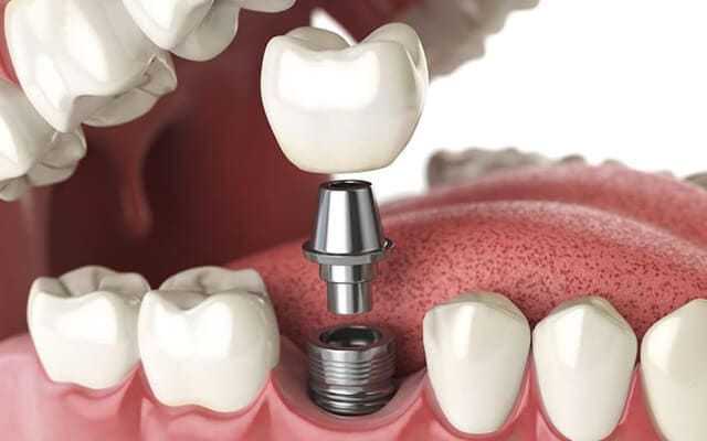 Ưu điểm của trồng răng Implant