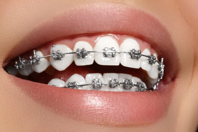 phương pháp niềng răng chỉnh nha