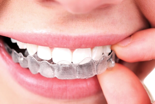 phương pháp niềng răng chỉnh nha