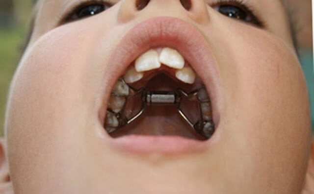Chỉ định nhổ răng