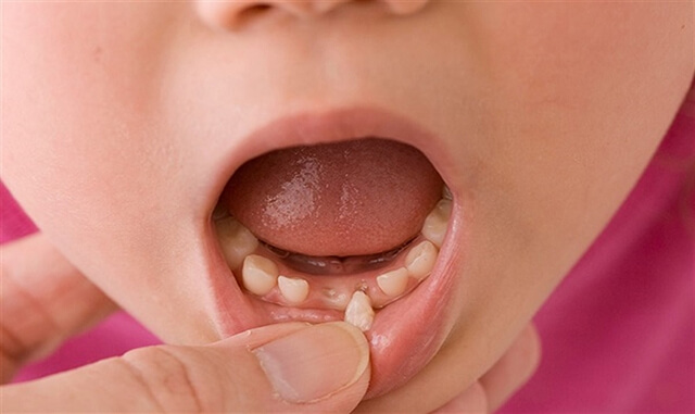nhổ răng sữa cho trẻ tại nhà