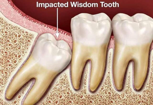 Răng khôn có tác dụng gì