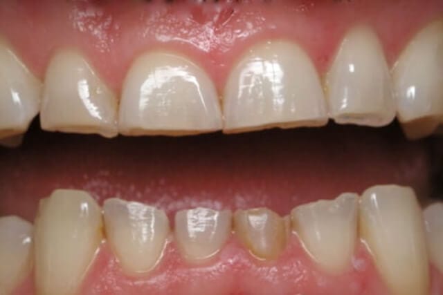 Mòn răng: Nguyên nhân triệu chứng chẩn đoán và điều trị