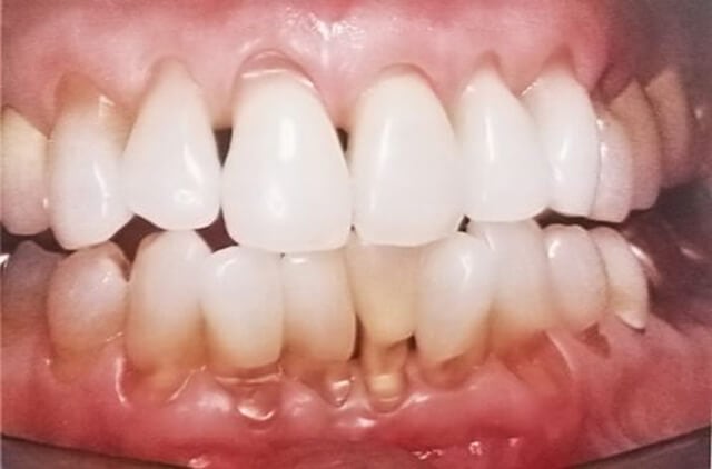 Mòn răng: Nguyên nhân triệu chứng chẩn đoán và điều trị
