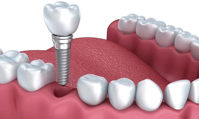 Nên trồng răng bằng cầu răng hay cấy ghép răng implant