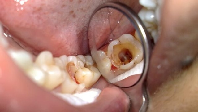 Viêm tủy răng khi nào cần điều trị