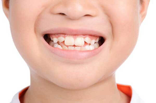 Răng mọc lệch ở trẻ