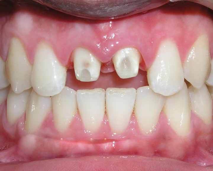ngăn chặn bọc răng sứ không chất lượng