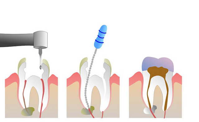 liệu pháp chữa tủy răng