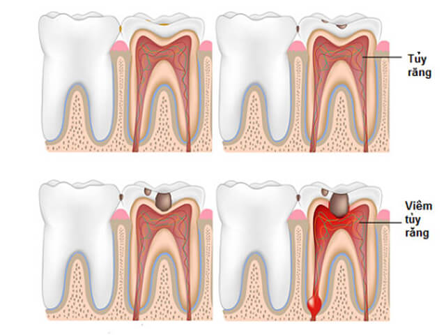 Phục hồi tủy răng