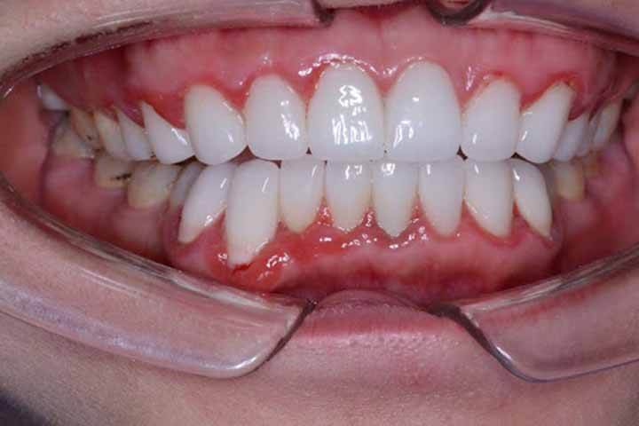 tác hại của việc bọc răng sứ