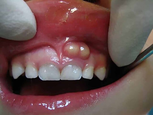 Triệu chứng viêm chân răng