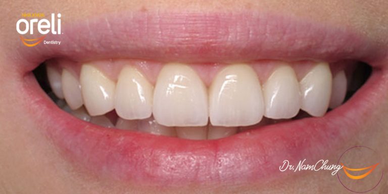 dieu tri cuoi ho loi