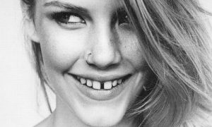 niềng răng khe thưa răng cửa