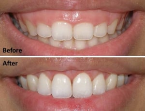 Điều trị cười hở lợi