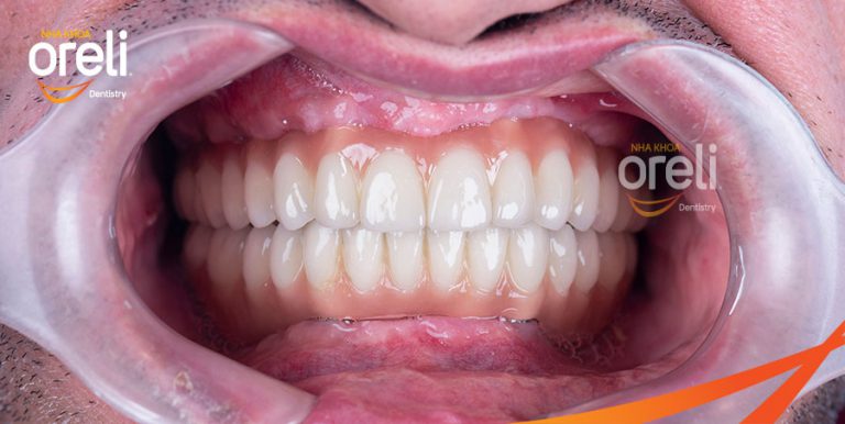 rang implant mat rang toan ham