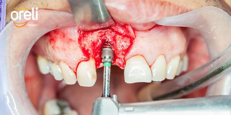 cay ghep rang implant oreli