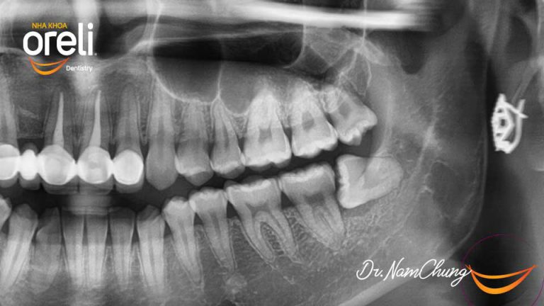 răng mọc lệch