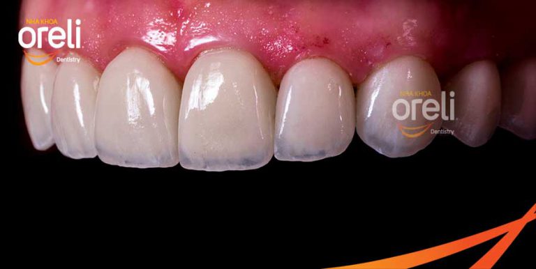 Làm mặt dán sứ Veneer tại nha khoa Oreli Buôn Ma Thuột