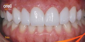 mặt dán sứ veneer