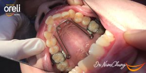 Niềng răng khí cụ chức năng biến đổi tăng trưởng (twinblock, quadhelix, transforce)