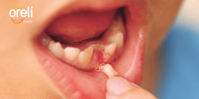 huong dan nho rang sua