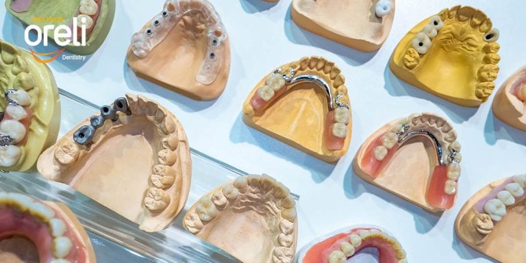 rang gia uy tin nha khoa oreli