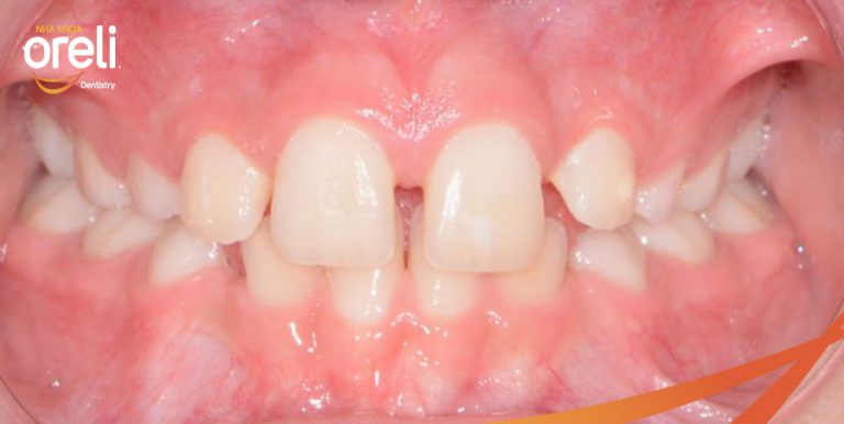 bọc răng sứ cho răng thưa giá bao nhiêu