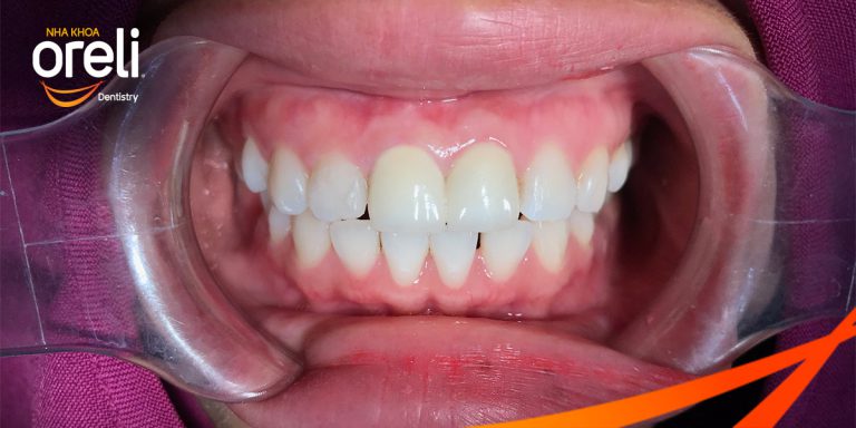 Bọc răng sứ nguyên hàm tại Buôn Hồ