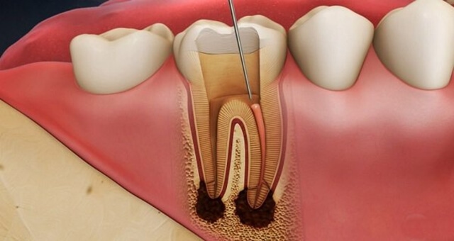 Viêm tủy răng khi nào cần điều trị