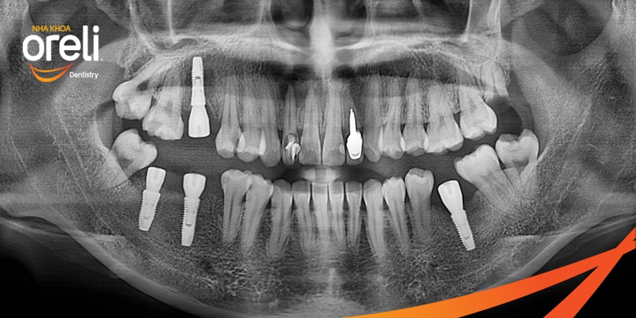 cấy implant uy tín bmt