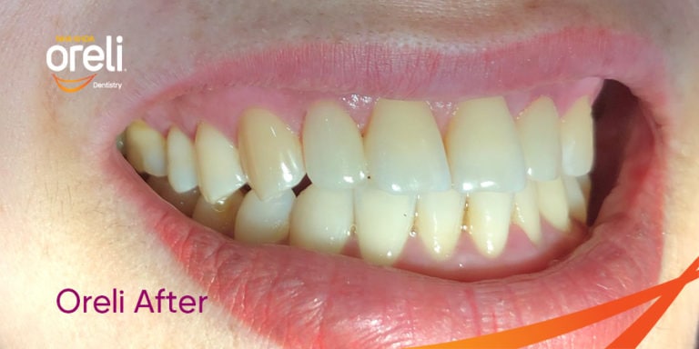 bọc răng sứ tại nha khoa Oreli