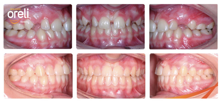 nieng khe thua rang cua