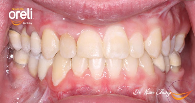 nieng rang uy tin daklak bmt