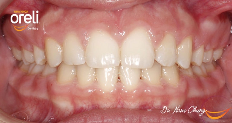 nieng rang chinh nha uy tin daklak bmt