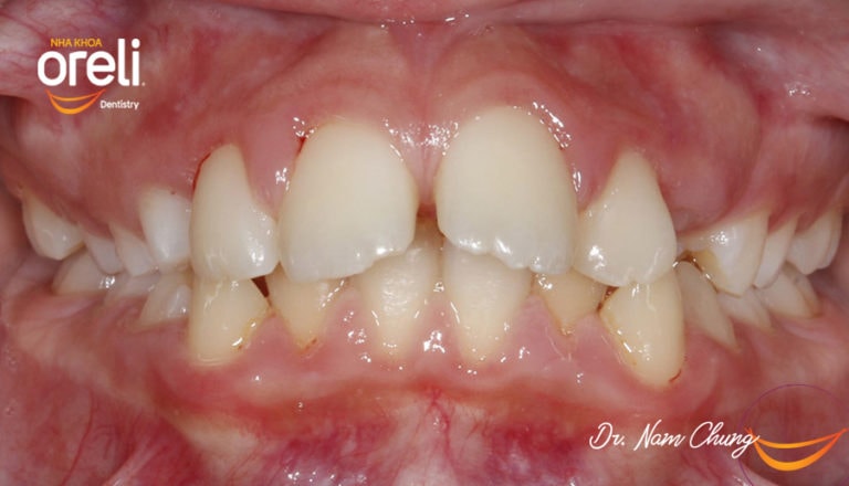 nieng rang chinh nha uy tin daklak bmt