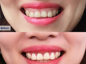 Điều trị cười hở lợi