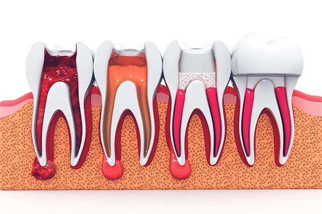 liệu pháp chữa tủy răng