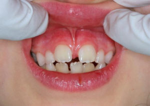 Phẫu thuật cắt phanh môi bám thấp gây thưa răng cửa