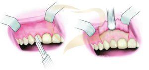 Phẫu thuật nạo nang cắt chóp