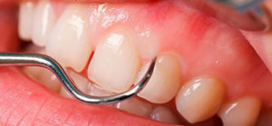 PHẪU THUẬT NHA CHU