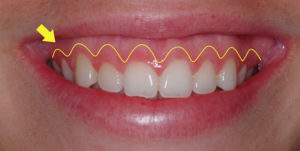 Phẫu thuật tạo hình đường viền nướu