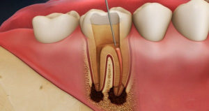 Phục hồi tủy răng