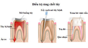 Quy trình điều trị tủy răng