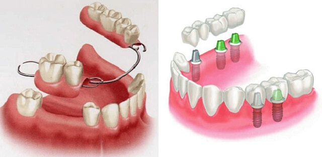 Răng giả và răng giả một phần