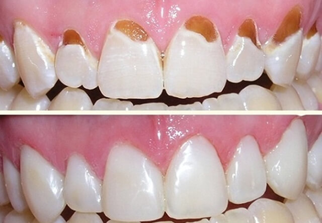 Trám răng & Chăm sóc phục hồi