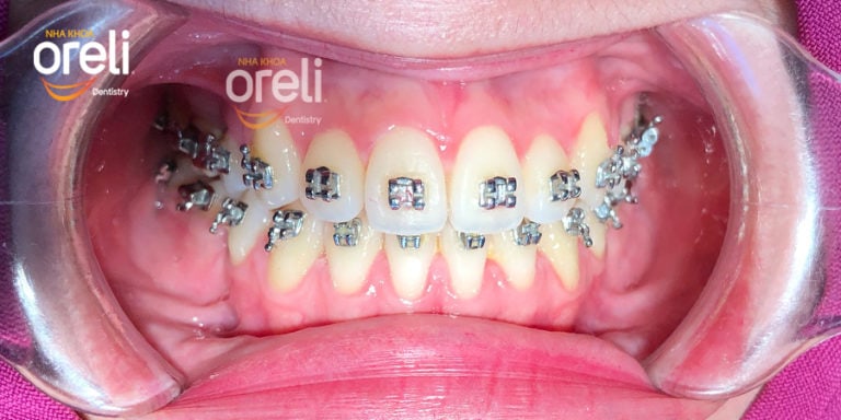 Niềng răng hệ thống mắc cài
