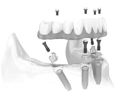 Trồng răng implant hết bao nhiêu tiền