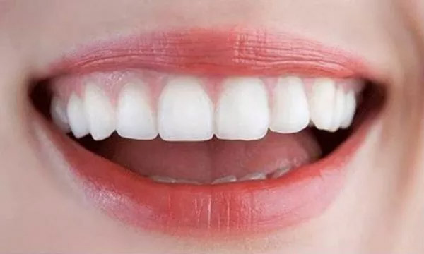 bọc răng sứ chữa hô